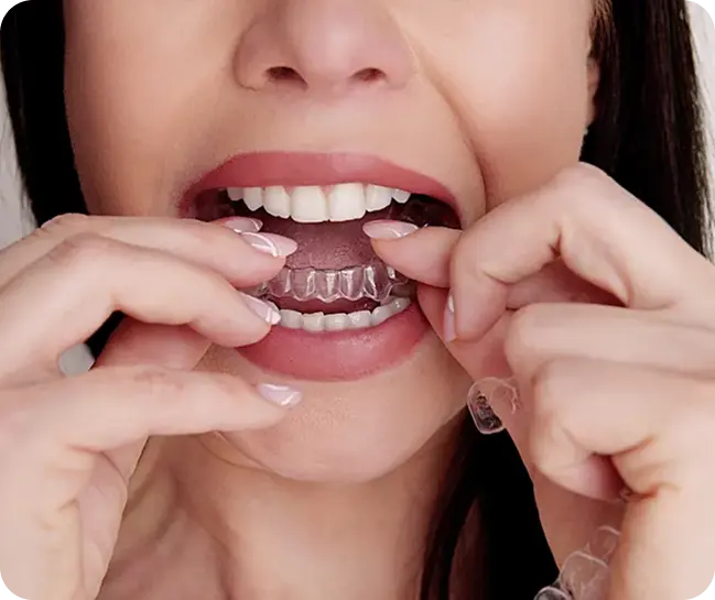Aligners