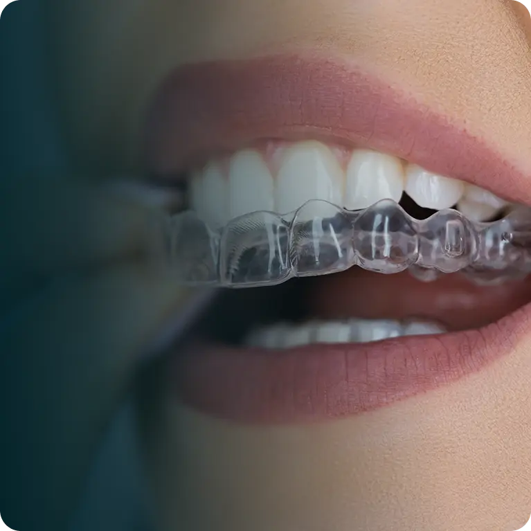 Aligners