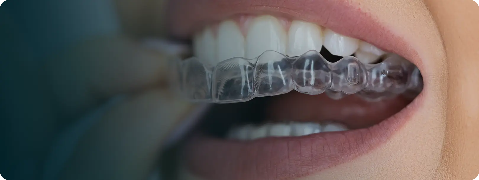 Aligners