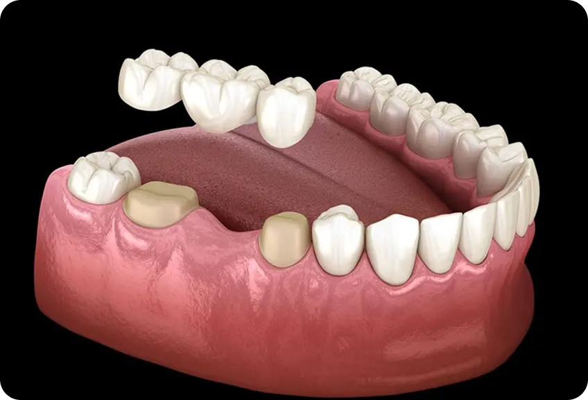 Dental Crowns & Bridges