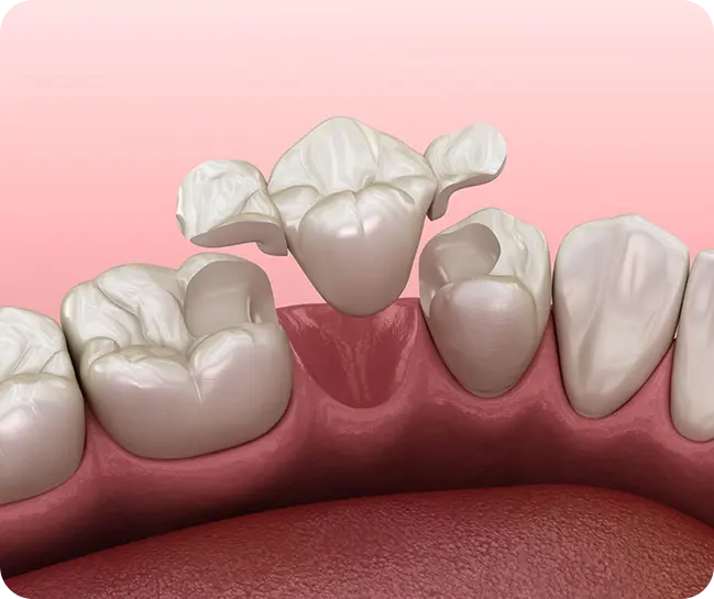 Dental Crowns & Bridges