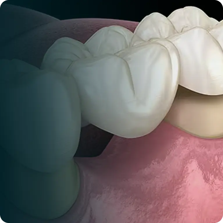 Dental Crowns & Bridges
