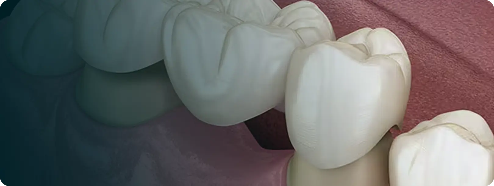 Dental Crowns & Bridges