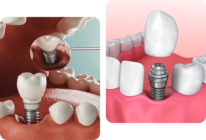 Dental Implants