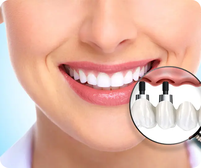 Dental Implants