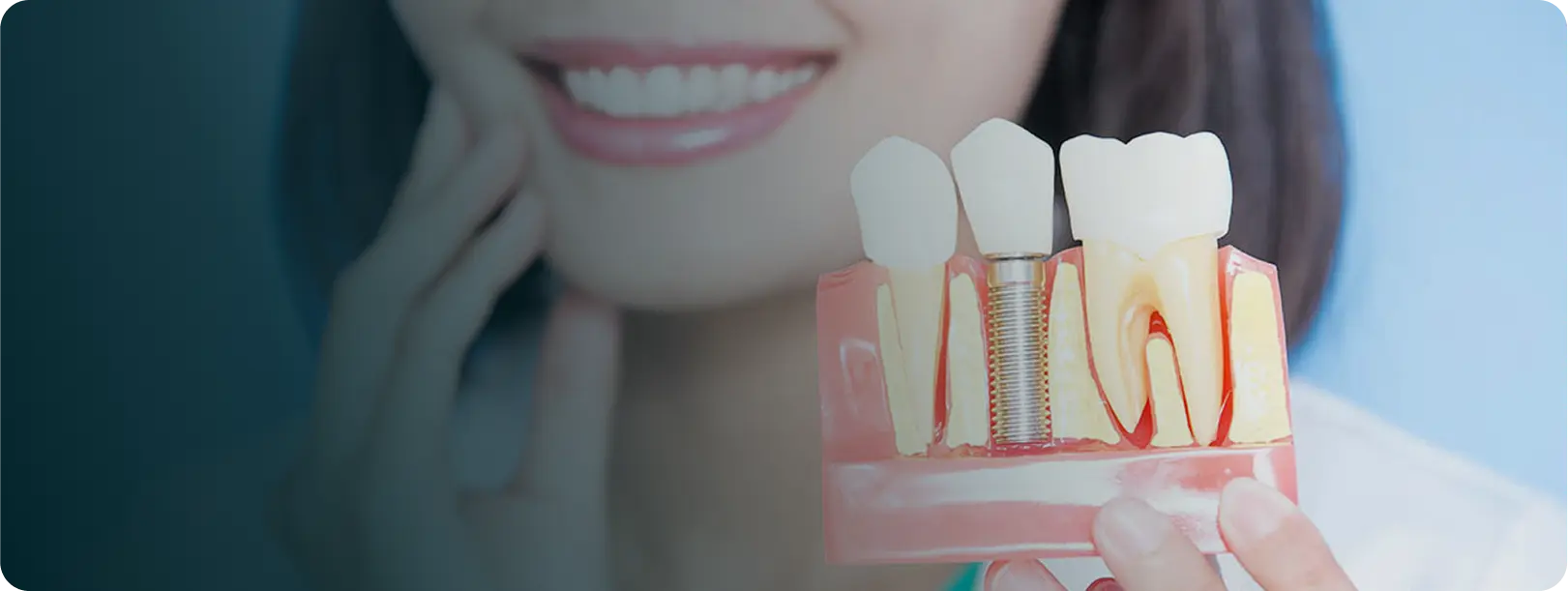 Dental Implants