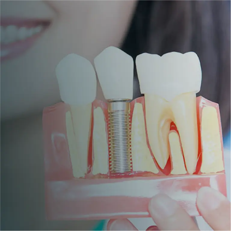 Dental Implants
