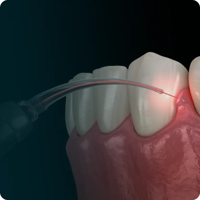 Laser Dentistry