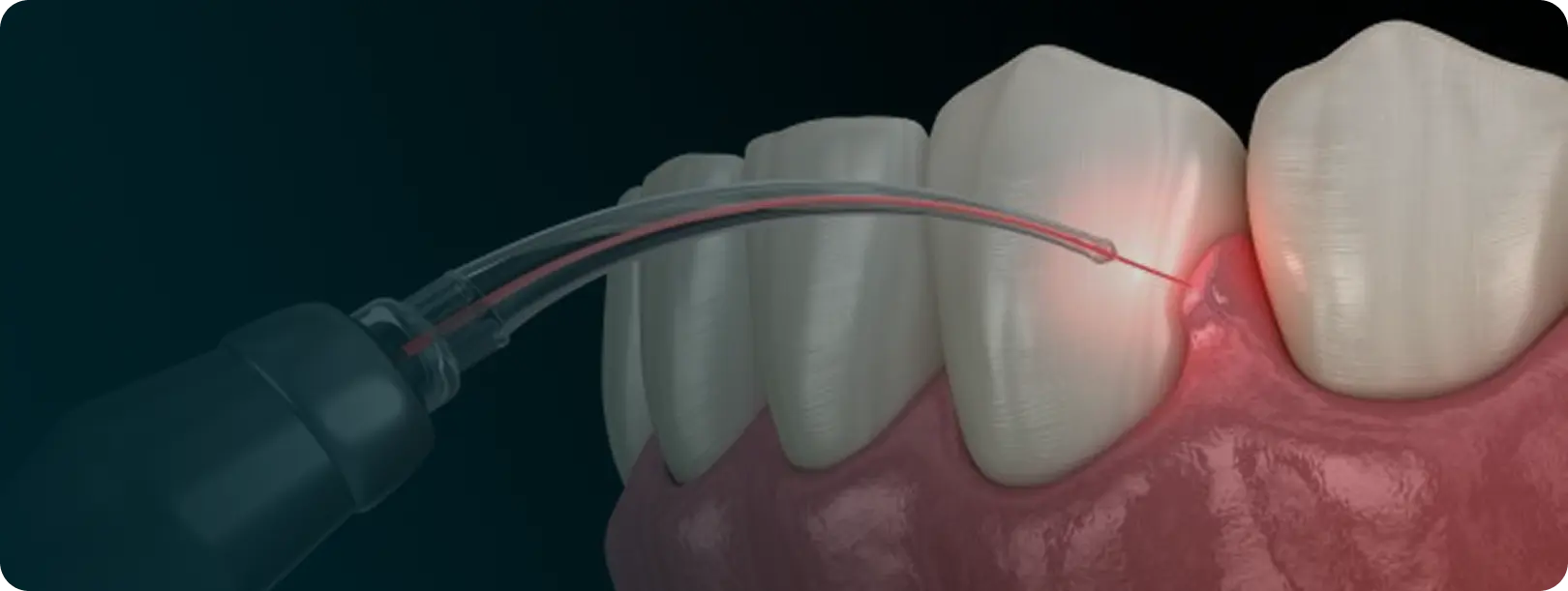 Laser Dentistry
