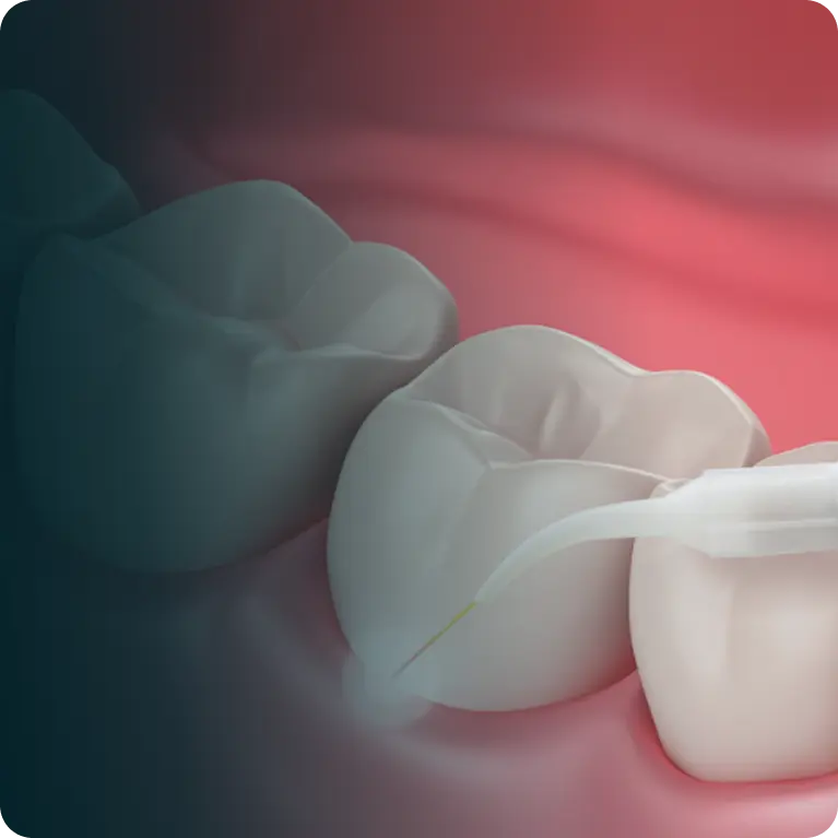 Periodontal Treatment