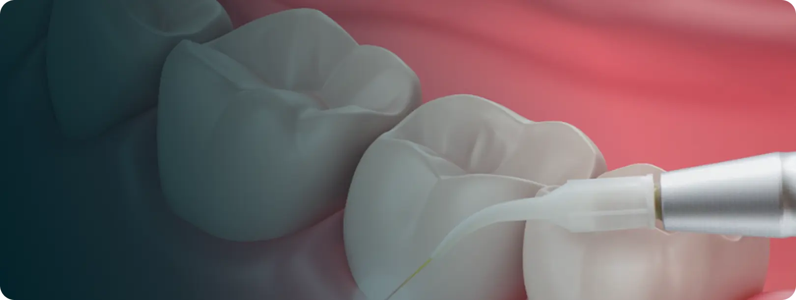 Periodontal Treatment