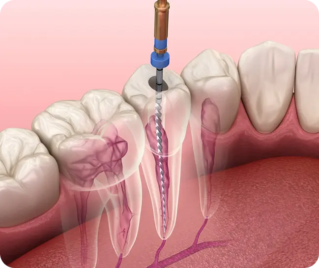 Root Canal Treatment