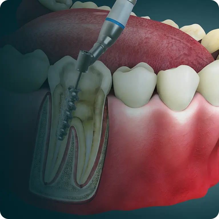 Root Canal Treatment