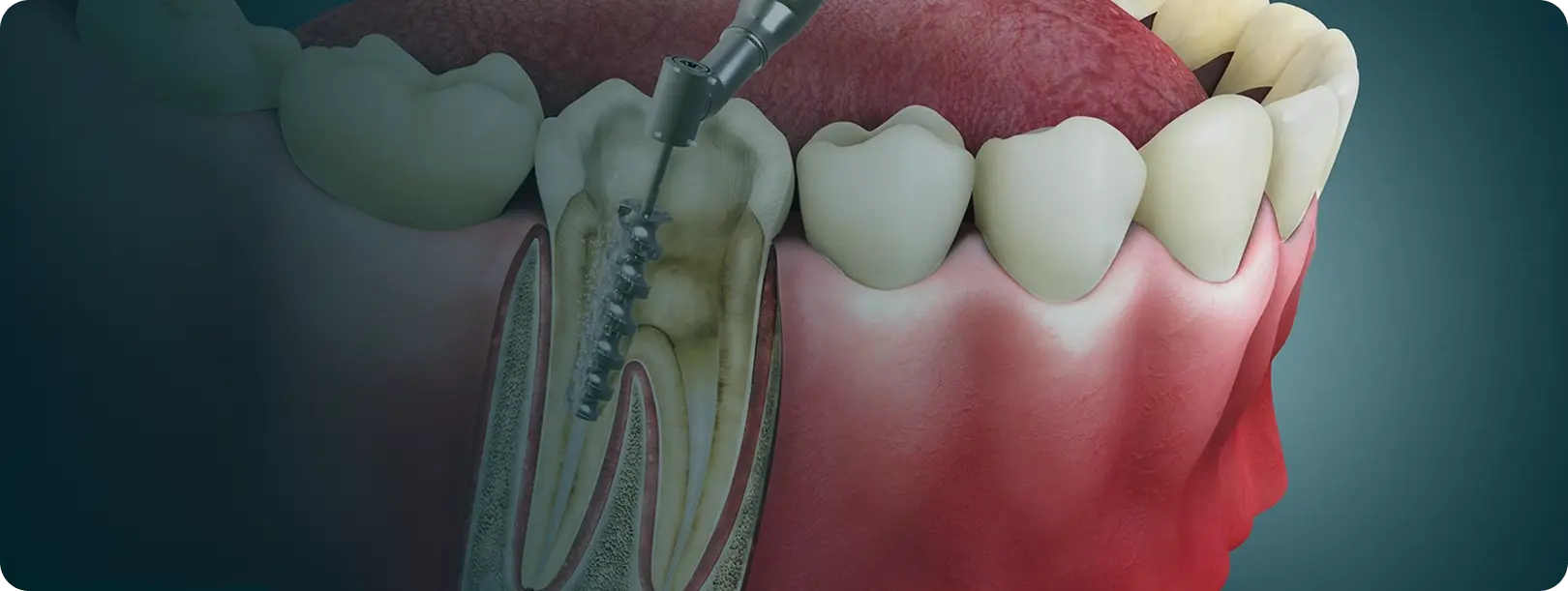 Root Canal Treatment