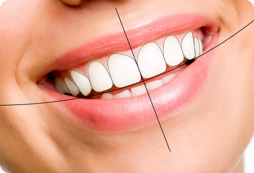 Smile Designing