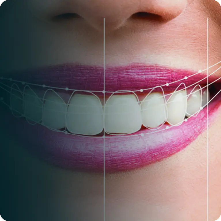Smile Designing
