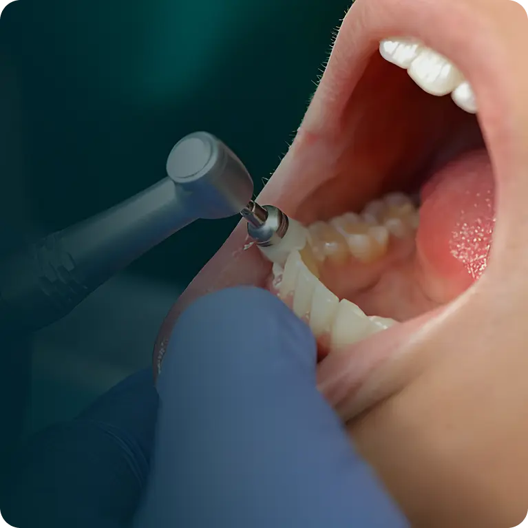 Teeth Cleaning