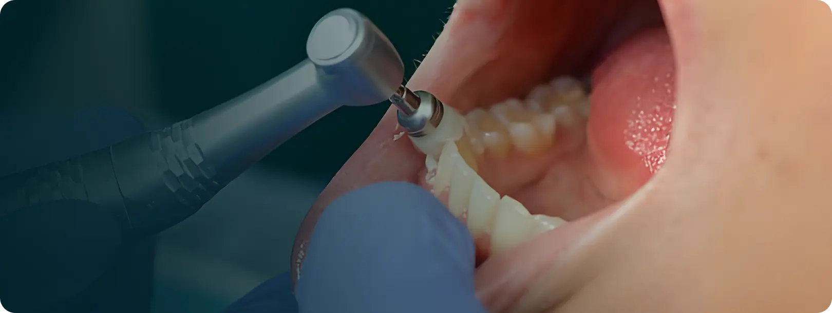 Teeth Cleaning