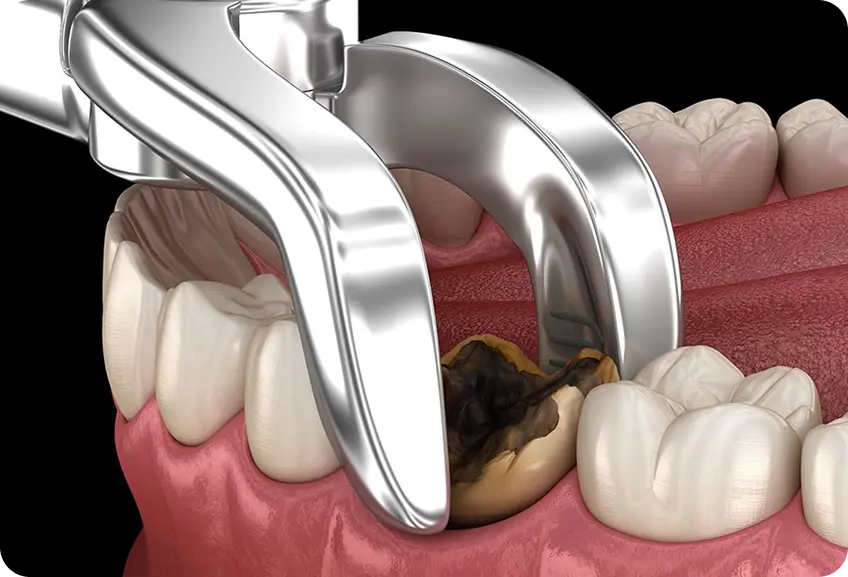 Tooth Extraction