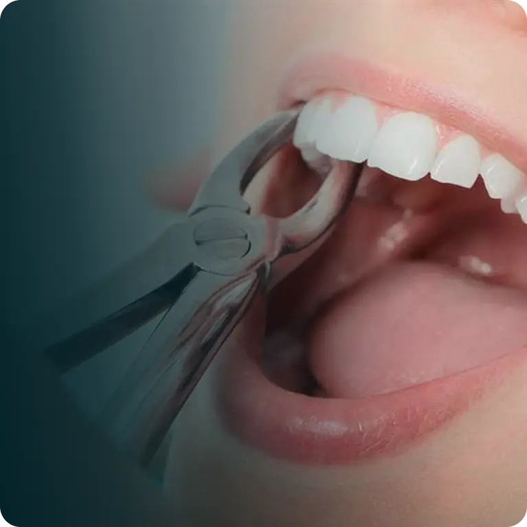 Tooth Extraction