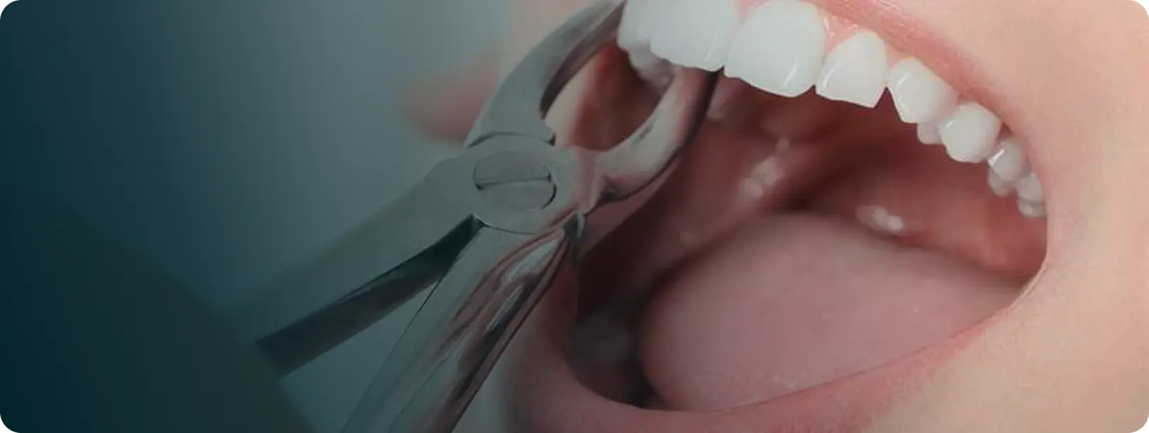 Tooth Extraction