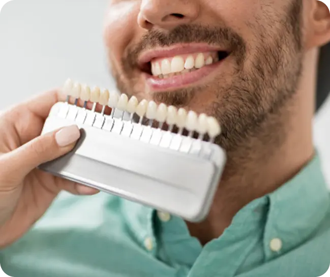 Veneers