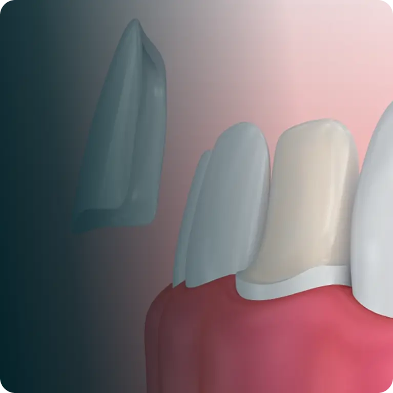 Veneers