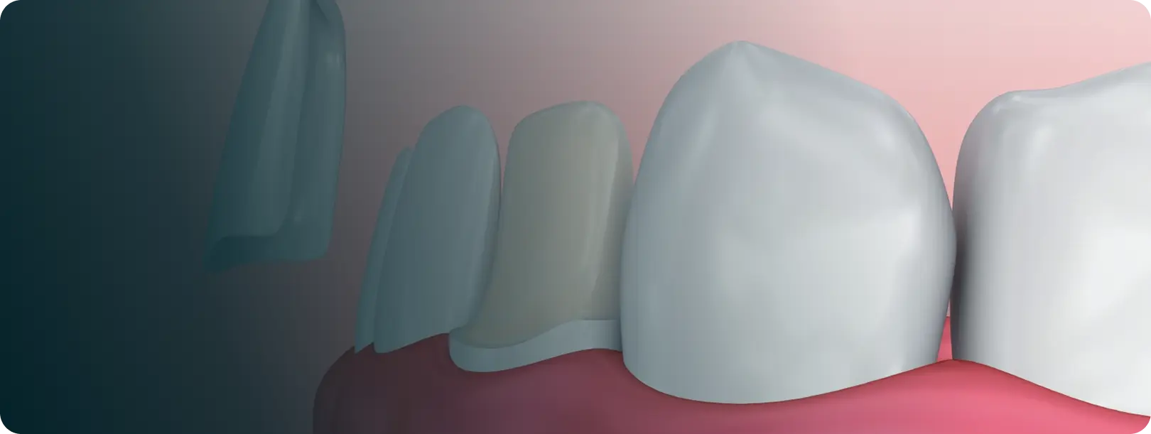 Veneers
